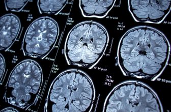 New Study Links Shingles to Cognitive Decline